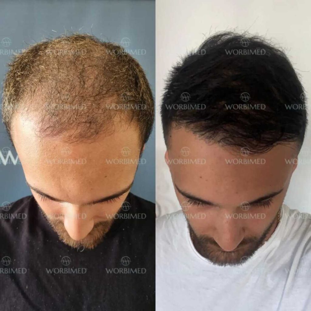 Eyebrow transplant