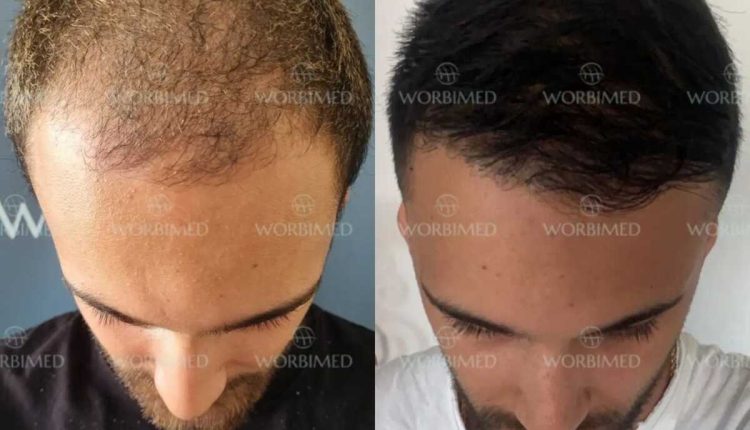 Eyebrow transplant