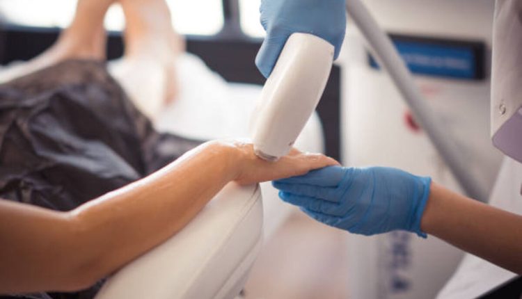 laser hair removal