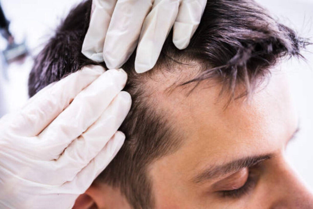Natural cures for Men's Hair Thinning