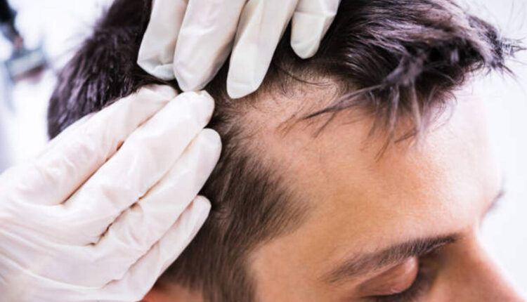 Natural cures for Men's Hair Thinning